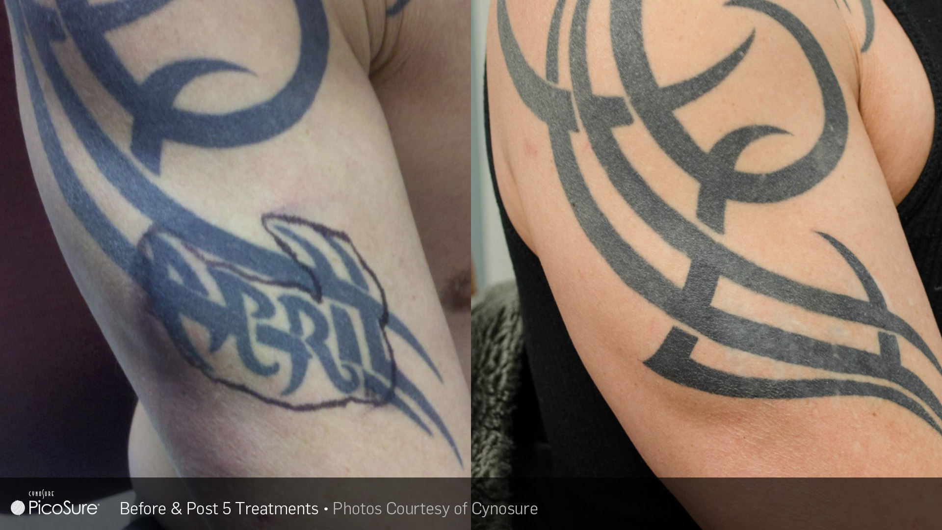Laser Tattoo Removal Treatment - Beauty & Laser